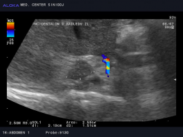 Ultrazvok ledvic - incidentalom desne nadledvične žleze